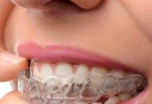 Invisalign in Kochi: What You Need to Know Before Choosing Clear Aligners